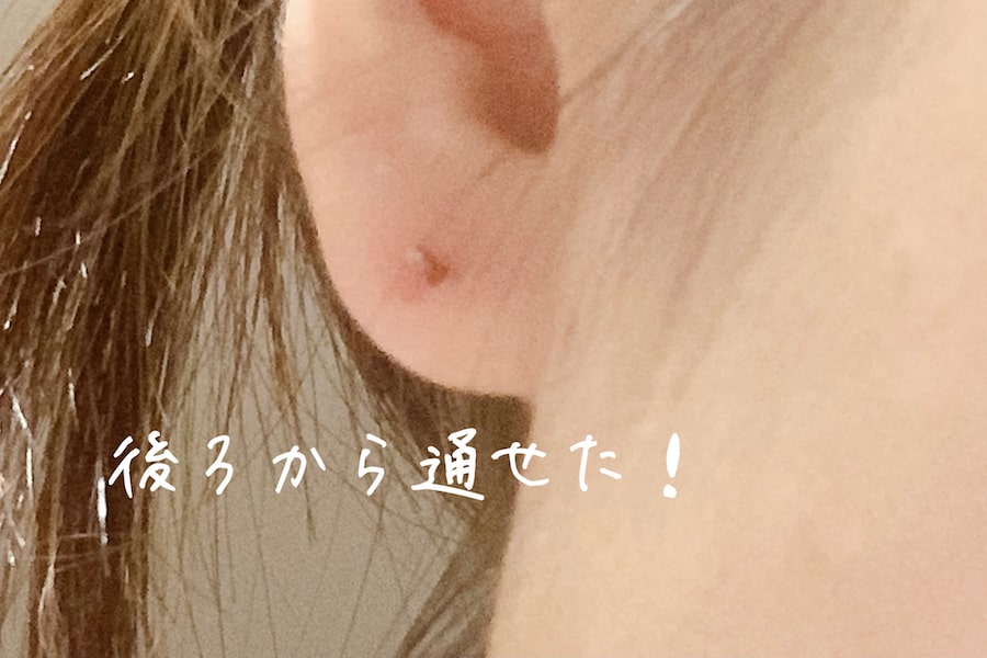 ピアス拡張器が通ったところ